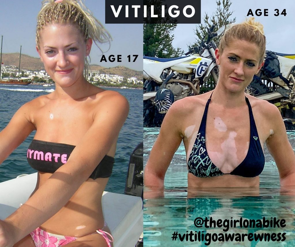 Vitiligo how it spreads - Vanessa age 17 and 34